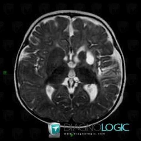 Porencephalic Cyst Mri