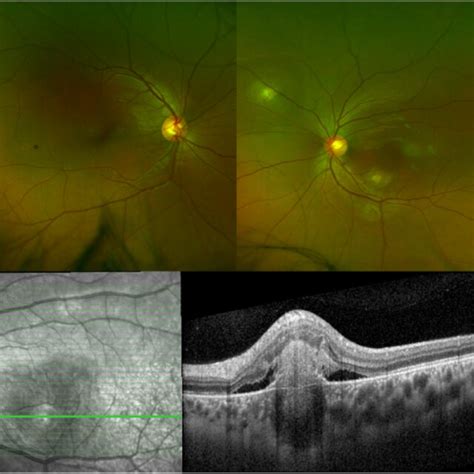 Fundus Photos Of The Right And Left Eye A And Oct Of The Macula Of