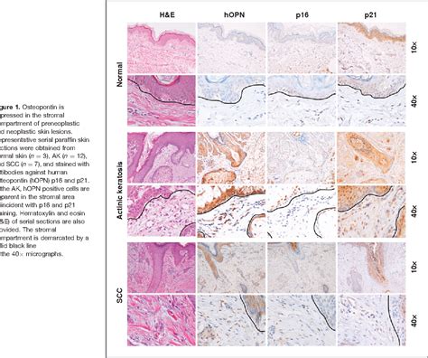 Figure From Angiogenesis Metastasis And The Cellular