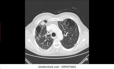 Lung Emphysema Ct Scan Stock Illustration 1094374601 | Shutterstock