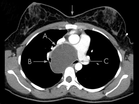 Bronchogenic Cyst Treated By Endobronchial Ultrasound Drainage Thorax