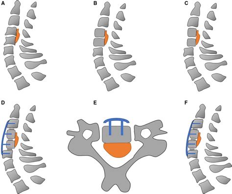 Frontiers The Effect Of K Line Classification In Different Cervical