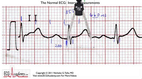 Interval Practice 6 5 Ecg Ekg Interpretation Basic Youtube