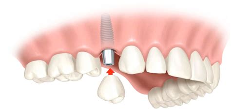 6 Pasos Para Colocar Un Implante Dental Dra Chandler