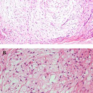 A Tumor Cells Arranged In Nodules Separated By Fibrous Septa H E