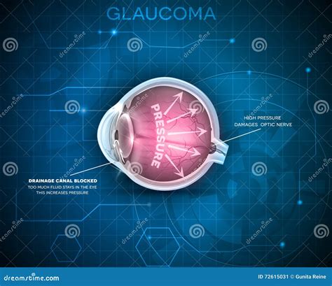 Glaucoma, vision disorder stock vector. Illustration of eyesight - 72615031