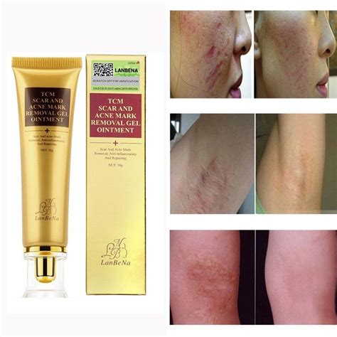 30g Acne Scar Removal Cream SCAR ACNE MARK REMOVAL GELProfession ...