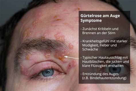 Gürtelrose am Auge Symptome Behandlung Spätfolgen