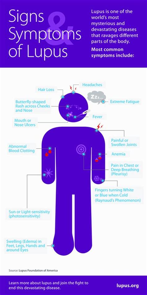 Diagnosing Lupus Lupus Association Of Nsw Inc