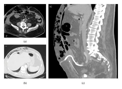 78 Year Old Male With Diagnosis Of Postsurgical Necrotizing Fasciitis