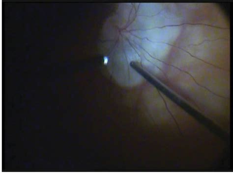 Figure 2 From Clinical Ophthalmology Dovepress Dovepress Progressive