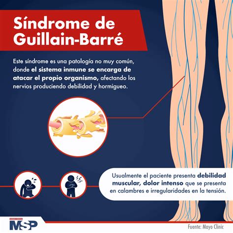 Guillain Barre Syndrome Archyde