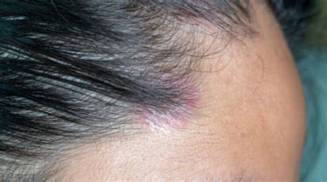 Scalp Psoriasis Symptoms, Signs, Causes, Remedies, And Treatments