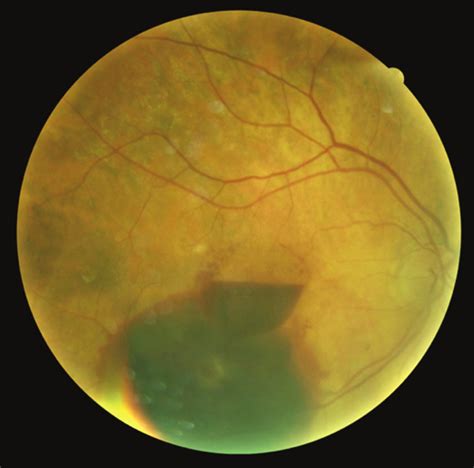 Hemorrhagic Retinal Arterial Macroaneurysm Associated With A