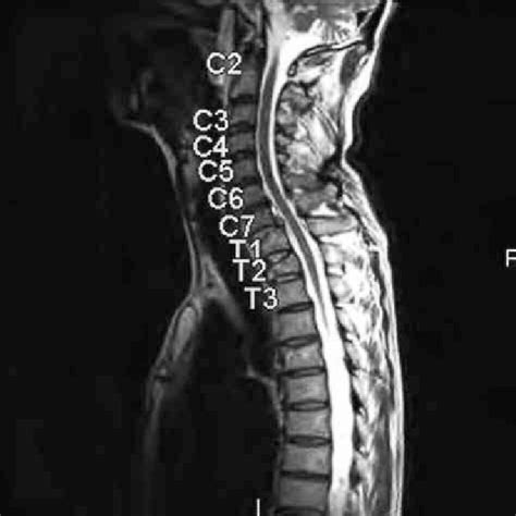 Mri Demonstrating Disruption Of Anterior And Posterior Longitudinal