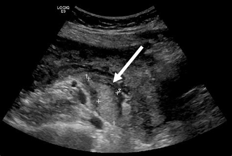 Ultrasonography Of Pelvis The Right Ovary With An Echogenic Mass Download Scientific Diagram