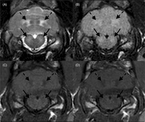 Transverse Images At The Level Of The Vestibular Nuclei A T2w Download Scientific Diagram