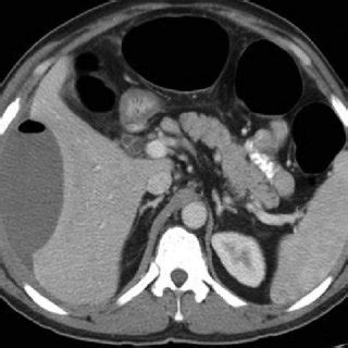 Contrast Enhanced Computed Tomography Scan Showing Subcapsular Hematoma