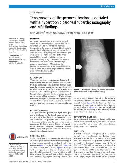 [PDF] Tenosynovitis of the peroneal tendons associated with a ...