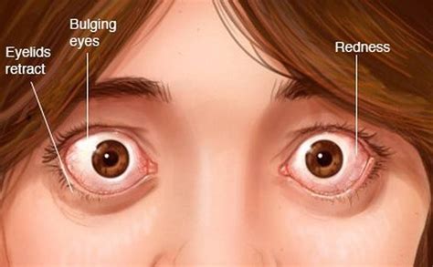 Ophthalmologist Rochester Ny Eye Surgeon Envision Eye And Aesthetics Graves Disease Symptoms