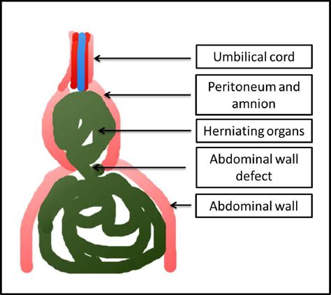 Figure 1 From Prenatal Anterior Abdominal Wall Defects A Radiologic