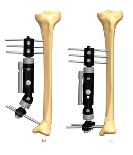 C For Correction Of Deformity Orthofix