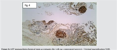 Figure 4 From A Rare Case Of Hemophagocytic Lymphohistiocytosis In A