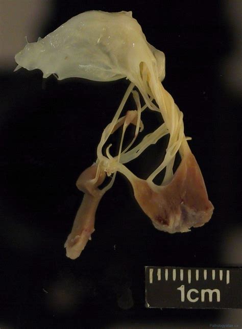 Papillary muscle rupture | Atlas of Pathology