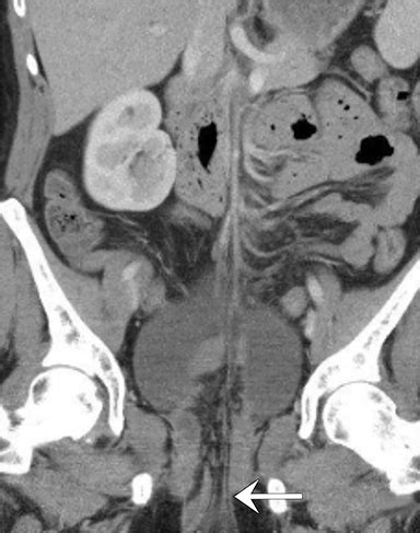 Vaginal Cuff Dehiscence And Small Bowel Evisceration VCDE Applied