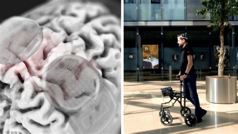 Increíble innovación médica implante cerebral devuelve la capacidad de