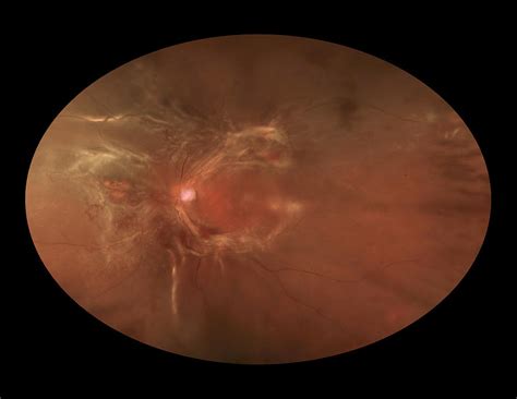 Proliferative Diabetic Retinopathy Photograph by Paul Whitten - Pixels