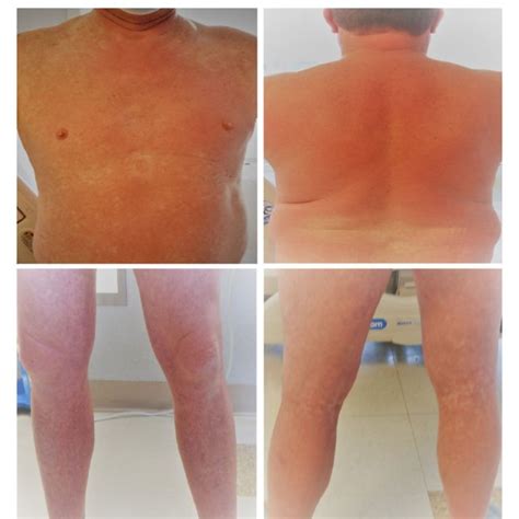 Patient With Generalized Blanchable Maculopapular And Morbilliform Rash