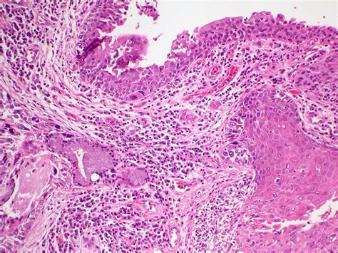 In Situ And Invasive Squamous Cell Carcinoma Case 224 A Photo On Flickriver