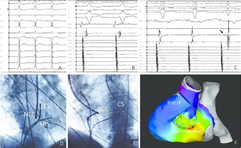 A Twelve Lead Ecg Strip Showing Overt Pre Excitation B Mapping In