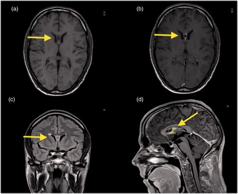 Spontaneous Dissolution Of A Cyst Located Within The Septum Pellucidum