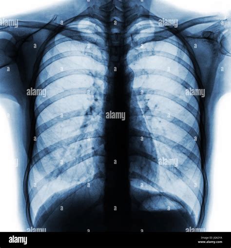 Film Chest X Ray PA Upright Show Normal Human Chest Stock Photo Alamy