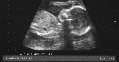 D_1986: 22 WEEKS PREGNANT ULTRASOUND