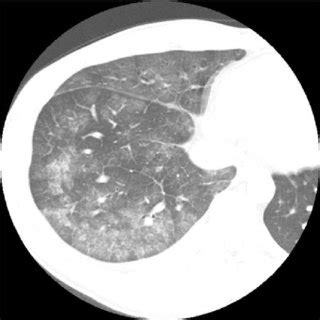 Summary Of Cases Of Presumed Daptomycin Induced Eosinophilic