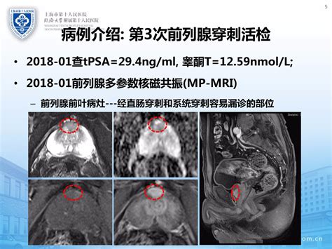 前列腺癌早期诊断的融合靶向精准穿刺活检实战病例 微医（挂号网）