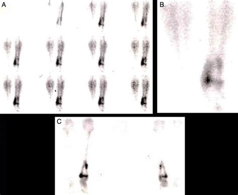 Three-phase bone scan showed increased uptake in the flow phase (A ...