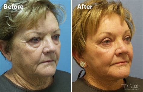 Face And Neck Lift 3 Dr Schalit Cosmetic Facial Specialist