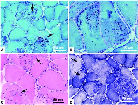 Muscle Biopsy Sections Of The Vastus Lateralis Muscle From Patient B