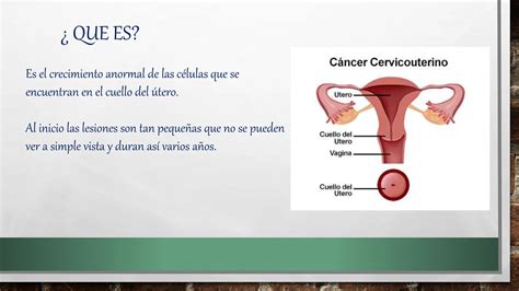 Cacu Cancer Cervicouterino Presentación Ppt