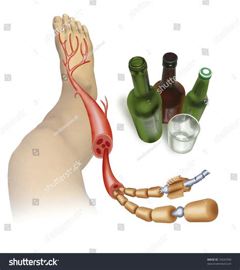 Realistic Illustration On Neuropathy Stock Illustration 72624700