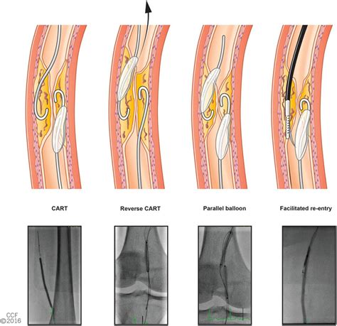 Percutaneous Therapies For Peripheral Artery Disease Circulation