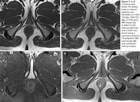 Figure 3 From Ideal Combination Of Mri Sequences For Perianal Fistula Classification And The