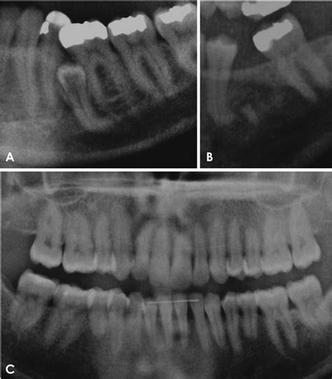 Dilaceration Teeth