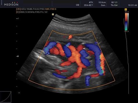 Ultrasound Images Umbilical Cord Color Doppler Echogramm №432