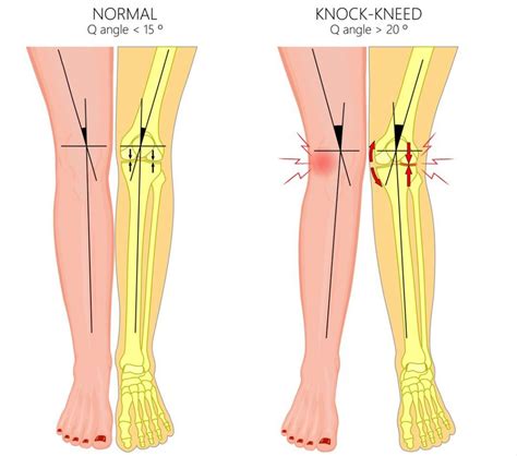 Knock Knees In Children Causes And Treatment Straits Podiatry