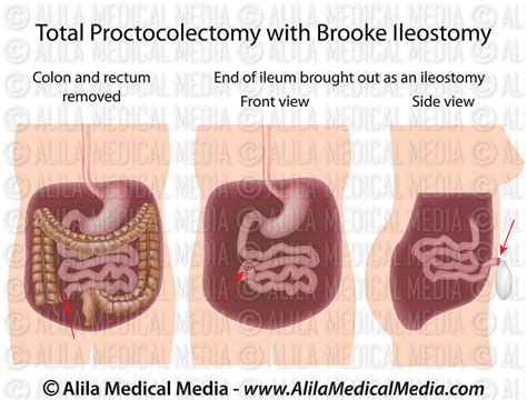 Alila Medical Media Total Proctocolectomy With Brooke Ileostomy